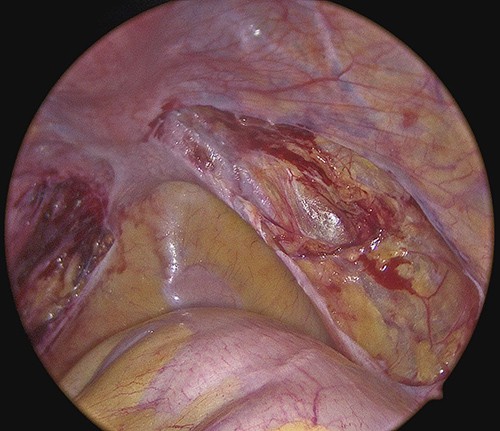 Endometriosis excision