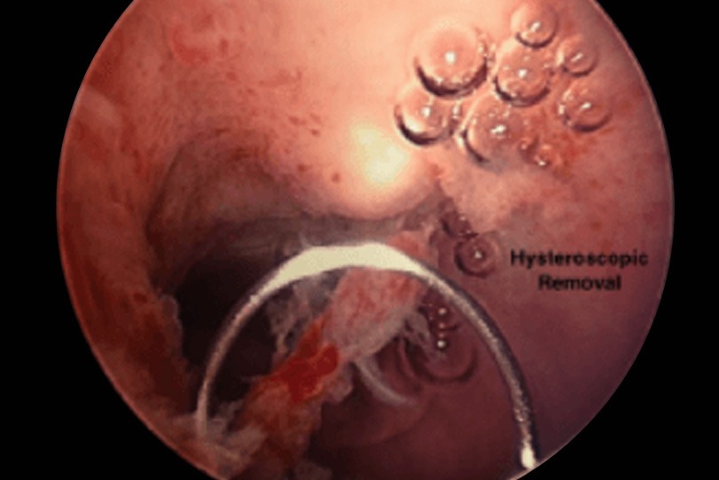 Hysteroscopic Removal