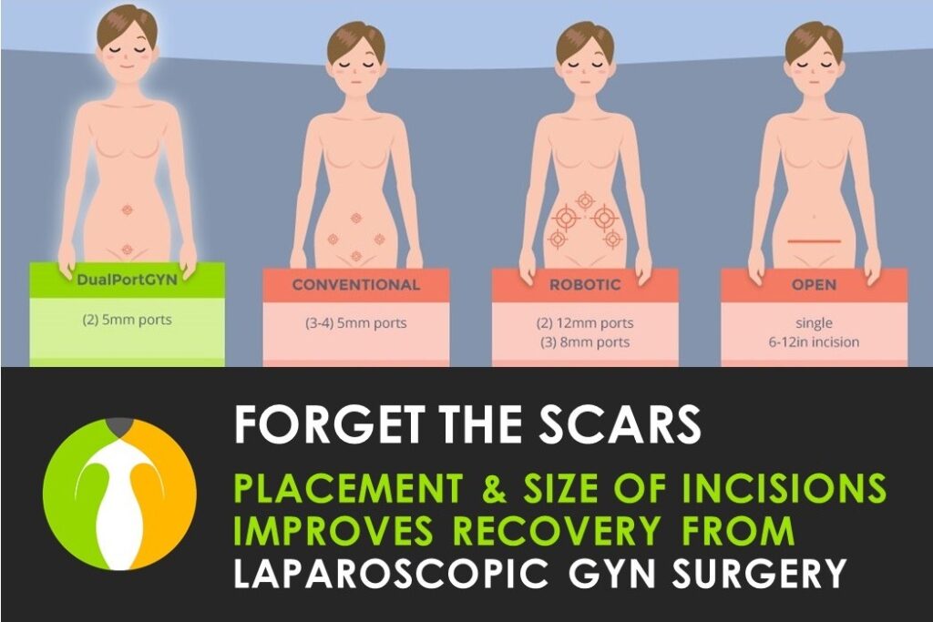 Laparoscopic GYN Surgery Scars