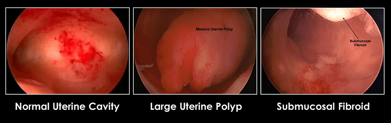 New-hysteroscopy-web-image