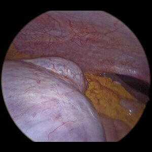 PIcture2-cyst-to-liver-500px-300×259