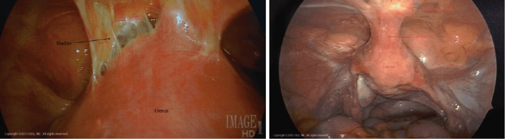 Resection-Pelvic-Adhesions