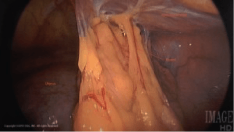 Resection-Pelvic-Adhesions