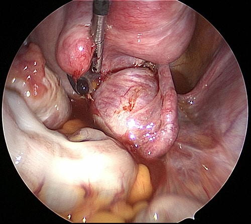 black endometriotic implant