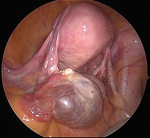 Serous Cyst of the Left Ovary