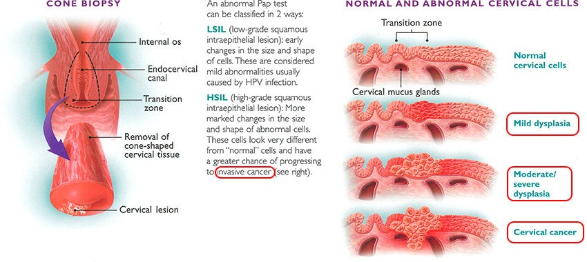 cervical-abnormalities-cancer