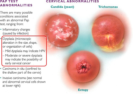 cervical-abnormalities