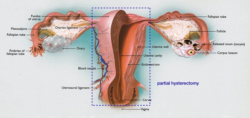 cigcpartial