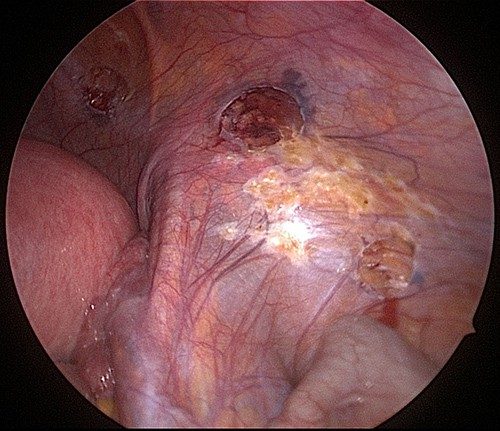 Endometriosis Cautery Excision