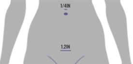 LAAM-2-incisions