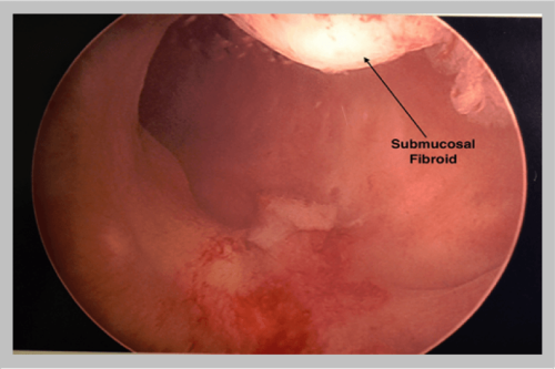 Submucosal-Fibroid