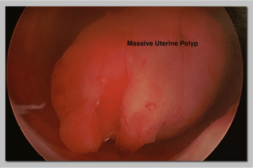 Uterine-Polyp