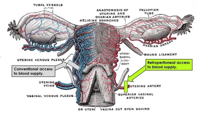 laam-fibroids