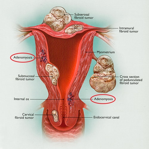 fibroid-adenomyosis-uterus