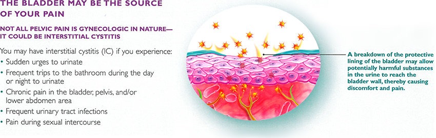 interstitial-cystitis-bladder